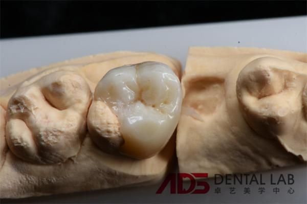 Buy cheap Strong Biocompatible Dental Composite Ceramic Inlay And Onlay Restorative Services from wholesalers