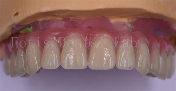 Patient Comfort Custom Dental Crowns Polished Titanium/Zirconia/PFM Implant
