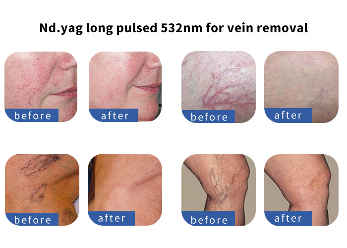 All Skin Types Thread Vein Removal Machine , Vertical Style Laser Acne Removal Machine