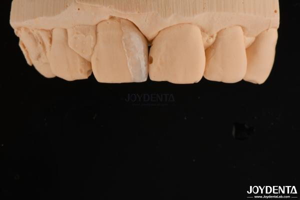 Buy cheap Thin Shell Micro Veneer Cosmetic Dental Treatment Micro Thin Teeth Veneers from wholesalers