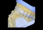 Zirconia Dental Crown Delivering Unbeatable Strength And Natural Smoothness,And