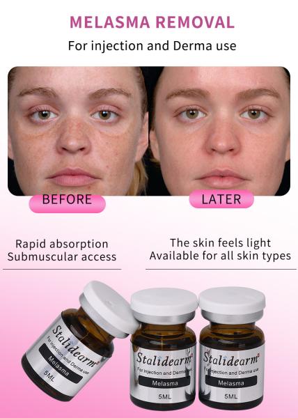 Buy cheap Stalidearm Dermal Fillers Improve The Look Of Freckle Facial Skin Care Melasma Treatment from wholesalers