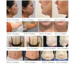 10 Handles Trusculpt ID Machine Portable Radio Frequency Fat Reduction Machine