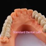 Buy cheap Digital Non Precious Metal Porcelain Crown PFM Bridge Dental from wholesalers