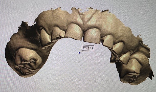3D Digital Mock Up Teeth Other Dental Products