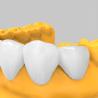 Buy cheap 3D Printed Bleach Temporary Veneer Resin for Dental Restorations from wholesalers