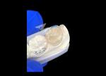 IPS E.max Ceramic Inlays Onlays Seamless Blend Natural-looking And Durable With