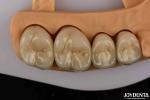 Premium Gold and Palladium Alloy Dental Crowns for Enhanced Durability
