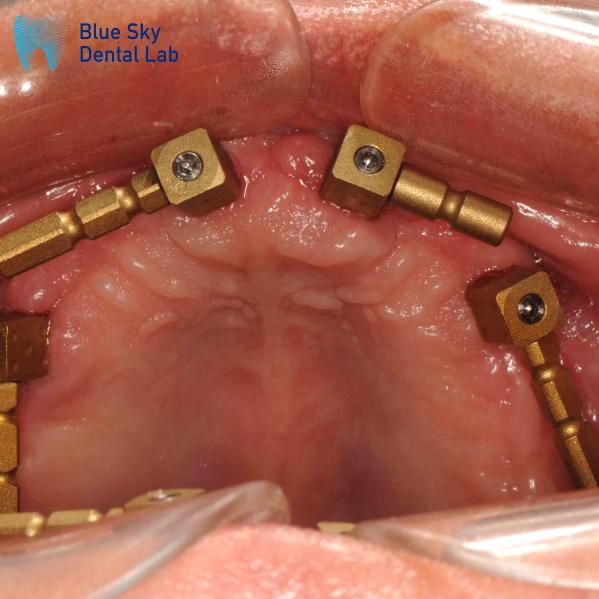 Buy cheap Gold Titanium Multi Unit Scan Body CAM System Dentium Scan Body from wholesalers