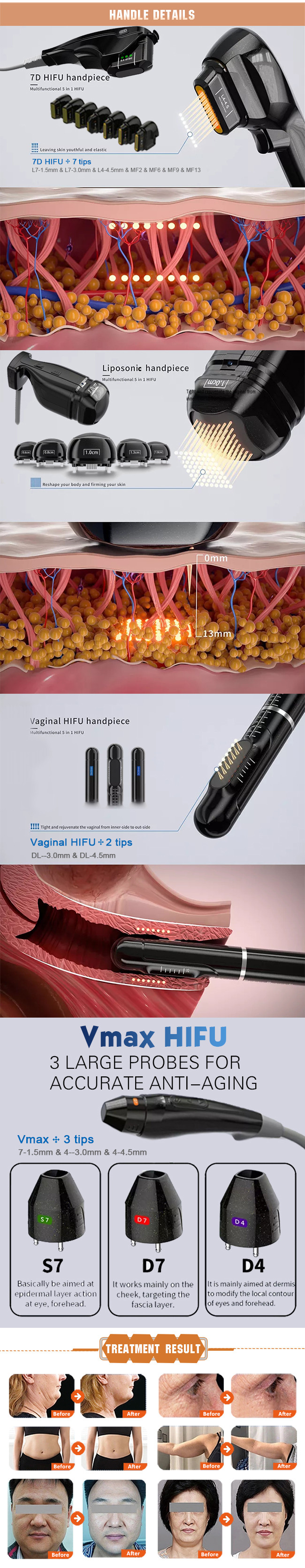 25mm HIFU Slimming Machine 3d Portable Hifu Ultrasound Facelift