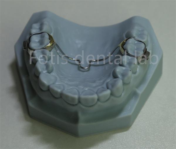 Versatile Dental Expander Retainer Affordable Solution for Most Orthodontic