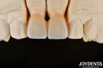 1350-1450°C Sintering Temperature Layered Zirconia For Superior Biocompatibility