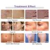 Buy cheap Portable Gold Micro Needle Equipment Radio Frequency Fractional RF Microneedle Machine For Ance Treatment from wholesalers