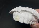 Translucent Custom Dental Veneers Fast and Effective Solutions for Long-Lasting