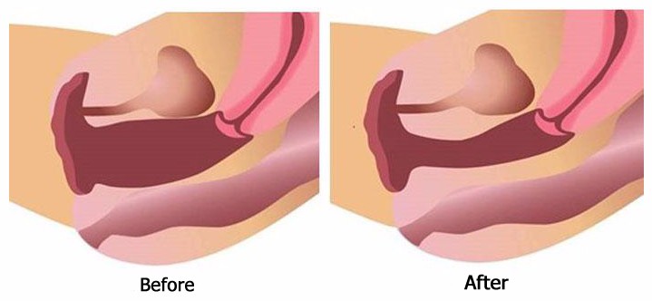 2016 Newest hifu vaginal tighten machine with easy and convenient operation