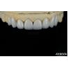 Buy cheap Long-lasting And Stain Resistant Dental Veneers With Personalized Shades For Natural Teeth from wholesalers