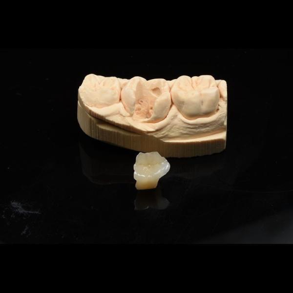 Buy cheap Metal Free Composite Crowns Inlays And Onlays Bridges Implants ODM from wholesalers