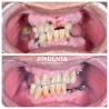 Buy cheap Resistant To Wear And Deformation Zirconia Dental Crowns Durable and Suitable For Posterior And Anterior Restorations from wholesalers