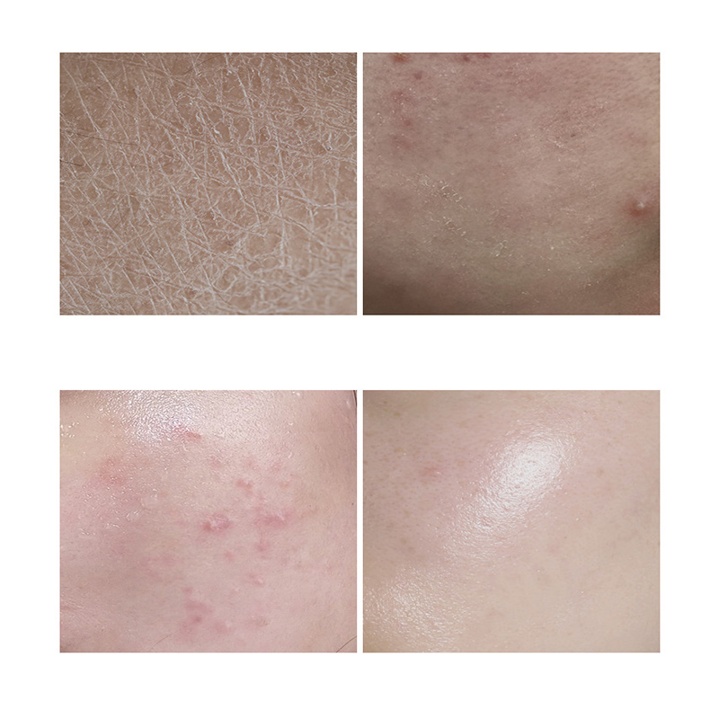 30ml Essence Face Serum 100% Pure Redness Radiant Skin Advanced Rosacea 1