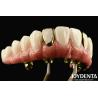 Buy cheap Experience The Durability Of Titanium Malong Hybrid Bridge For Applicable Dentistry from wholesalers