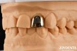 Experience Oral Rehabilitation Like Never Before With Gold Crown Wax Casting
