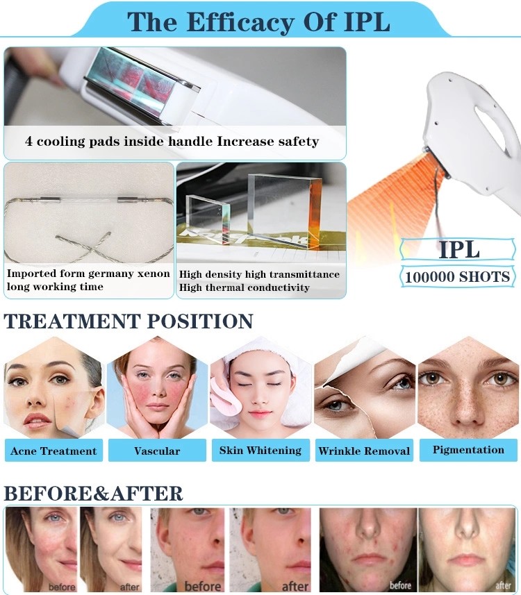 Nubway most powerful professional ipl permanent laser ipl hair remove skin rejuvenation photofacial beauty machine