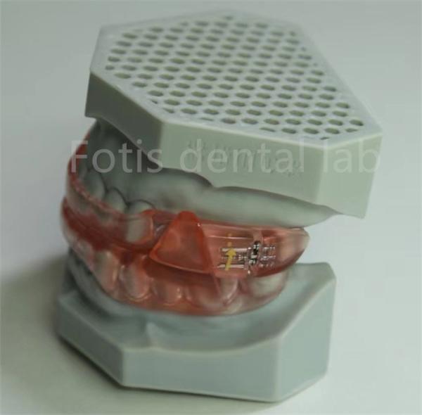 Buy cheap Affordable Dental Lab Hyrax Expander Orthodontic Retainer Easy To Clean And Maintain from wholesalers