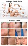 D32 Portable 808nm Professional Homeuse Diode Laser Hair Removal Machine Seeking