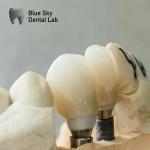 Single Crowns Zirconia Abutment Hypoallergenic Dental Implant Zirconia Abutment