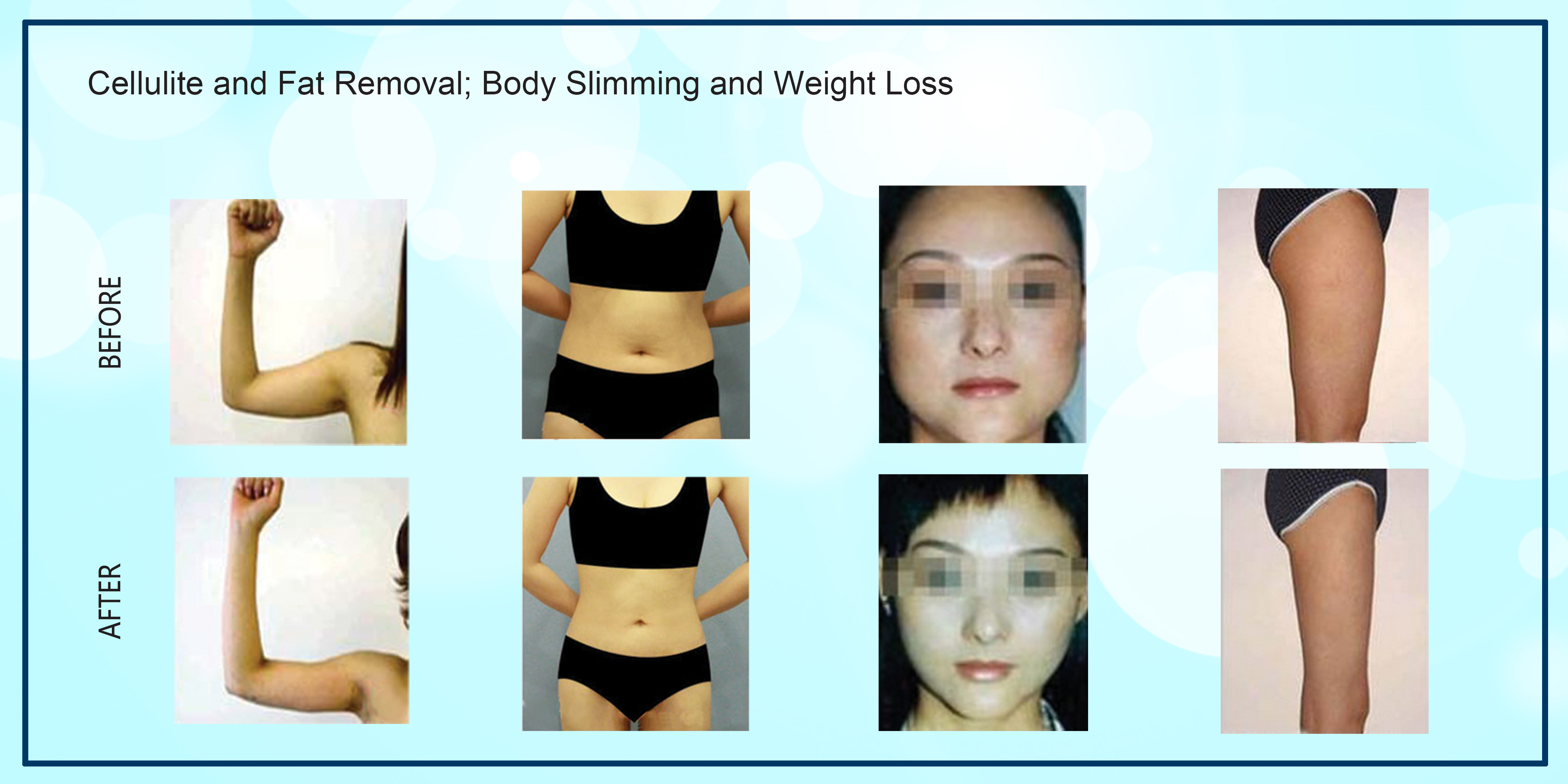 Anti - Puffiness Cryolipolysis Slimming Machine 2 Handles Cellulite Removal Machine