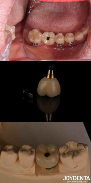 Buy cheap 4-6 Dental Endosseous Tapered Implant Subcrestal Bone Level And Internal Hex Connection from wholesalers