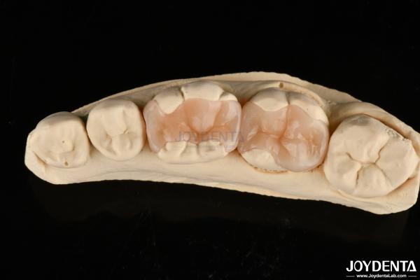 Buy cheap Natural Polymerized Porcelain Dental Inlay Onlay For Tooth Restoration from wholesalers