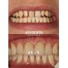 Buy cheap Long-lasting Dental Veneers No Discoloration Perfect For B2B Sourcing Needs And More from wholesalers