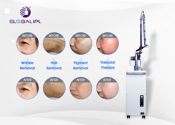 4 Handpieces Portable Laser Tattoo Removal Machine With 1 - 6hz Frequency