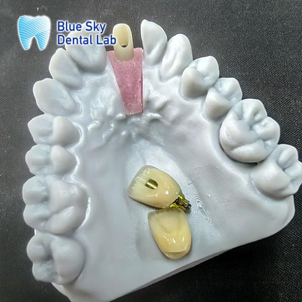 Buy cheap Precision Milled Zirconia Abutment With Single Implant Crown from wholesalers