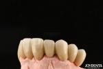 PFM Ceramic Fused To Metal Crown High Biocompatible and Corrosion Resistant