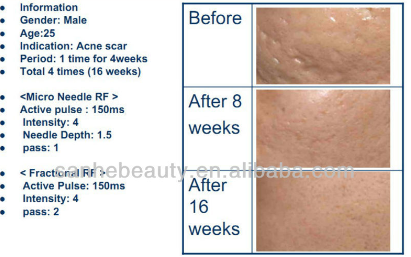 25 pins and 49 pin fractional micro needling rf fractional rf microneedle pantip