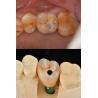 Buy cheap Titanium Full Arch Dental Implants Prosthetic Platform 4.1mm For Exceptional Durability from wholesalers