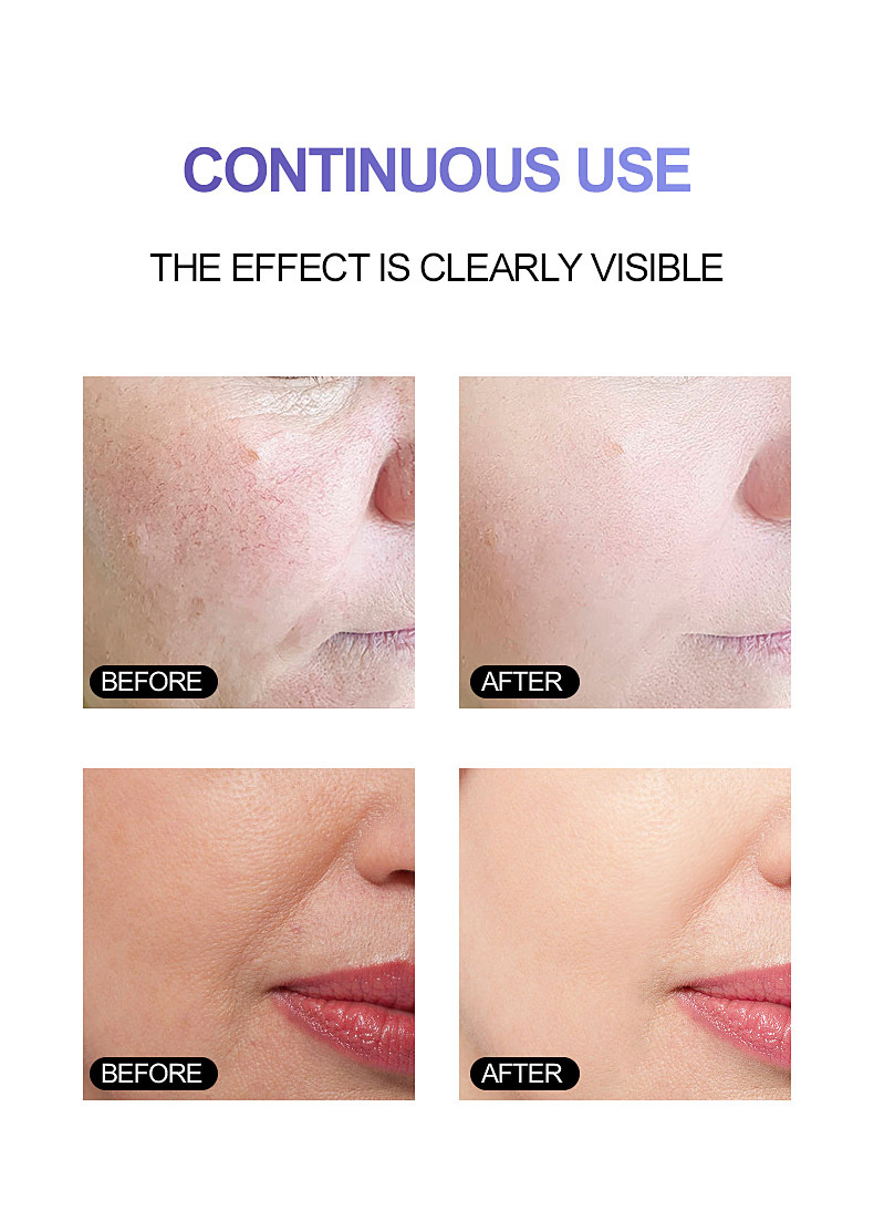 30ml Essence Face Serum 100% Pure Redness Radiant Skin Advanced Rosacea 1