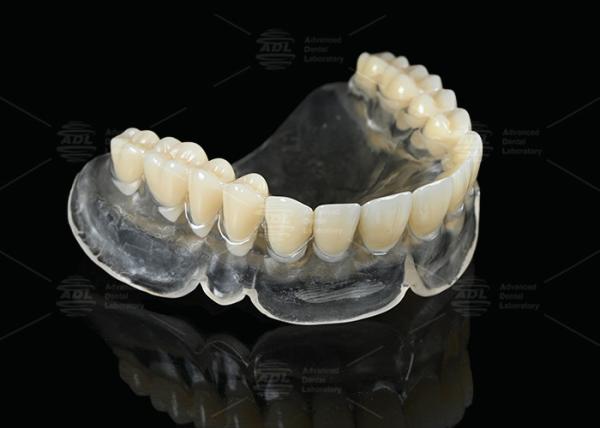 Buy cheap Heat Curing Vertex Thermosens Dentures For Clear Full Denture Wearers from wholesalers