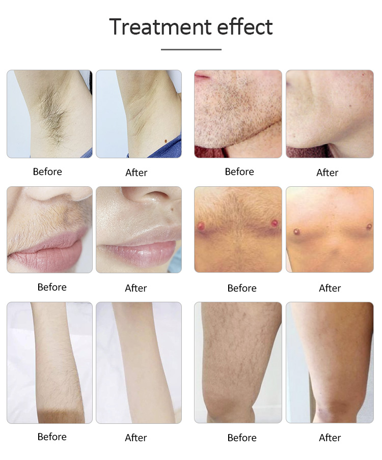 Portable 808nm Diode Laser Hair Removal Machine For Home hair removing laser machine lady hair removal machine