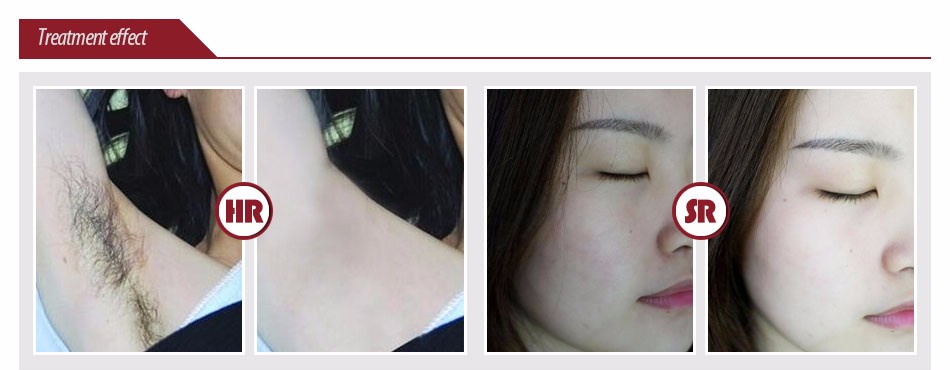 Home OPT SHR IPL Machine Ipl for Skin Rejuvenation Device CE Approved