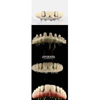 Buy cheap Dental Aesthetic Titanium Malong Hybrid Bridge Ultimate Solution For Dental product