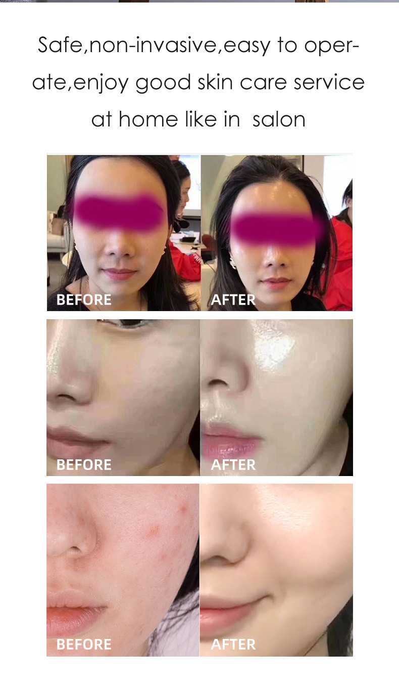 Skin Rejuvenation Beauty Parlour Products 2000W Diode Laser Machine