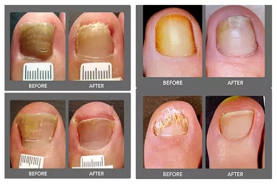 Class IV 980nm Diode Laser For Onychomycosis Therapy