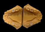 Biocompatible Ceramic Inlays Onlays Seamless Dental Restoration with Stain