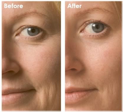 Pigment Removal / Skin Tightening,Skin Oxygen Facial Machine for beauty salon