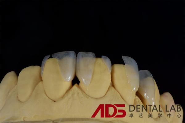 Buy cheap Dentures Aesthetic Emax All Ceramic Crowns Front Teeth OEM from wholesalers
