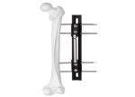 Medical External Fixator of bone lengthening, light and easy to do the operation