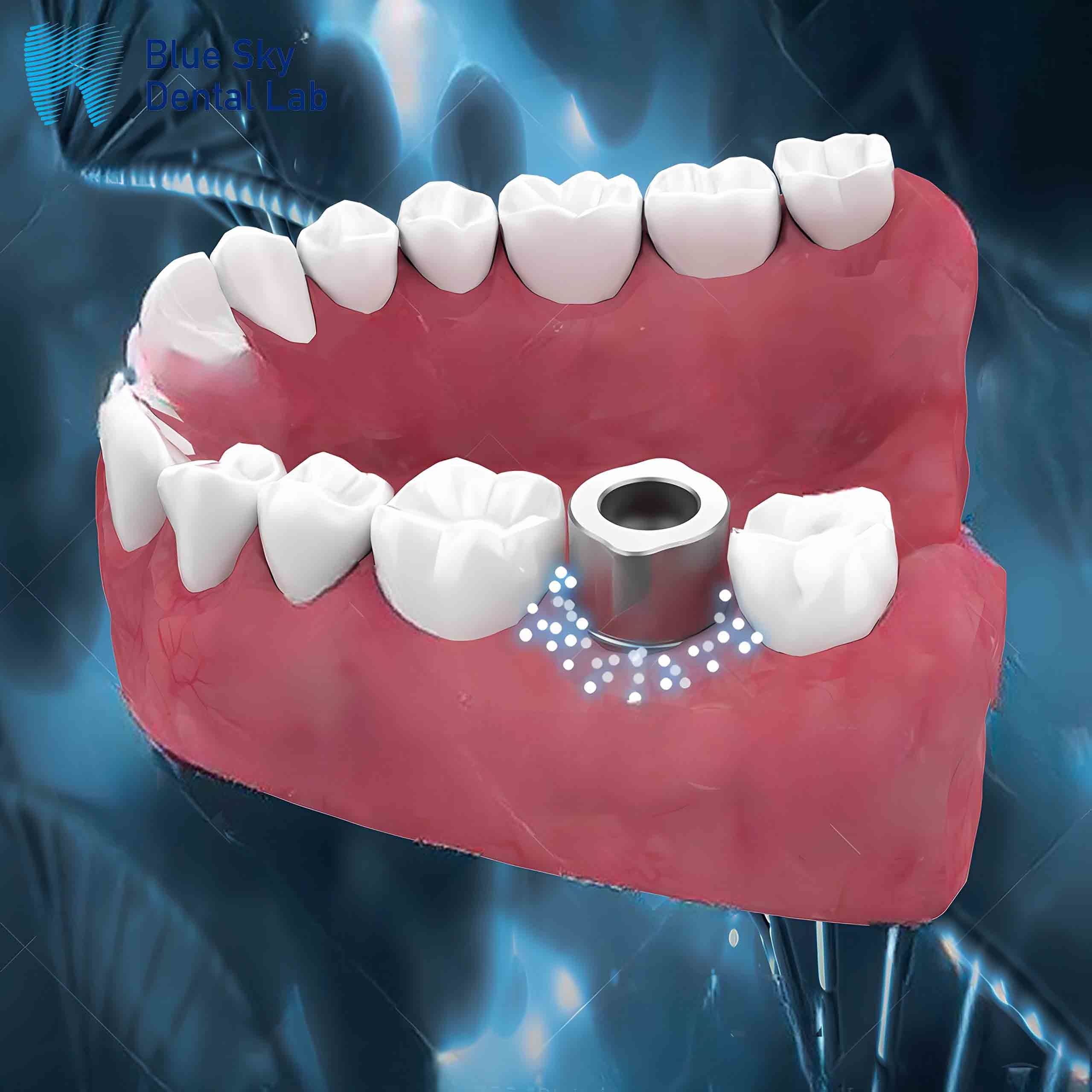 Reusable Dental Scan Body Healing Capsule For Direct Installation